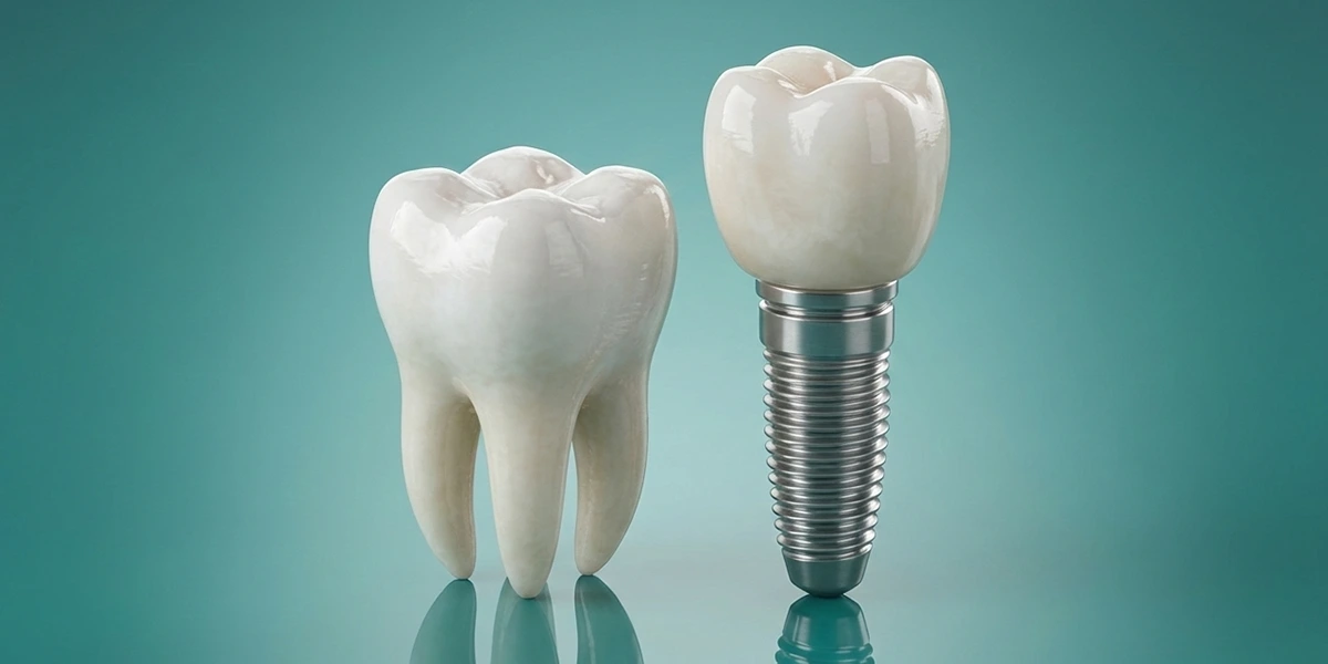 Dental Implants